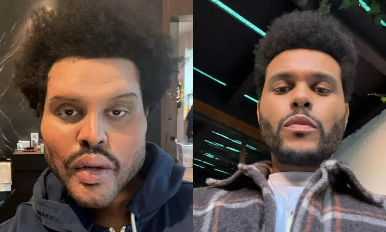 The Weeknd Plastic Surgery: The Real Story Behind His Changing Face the weeknd plastic surgery